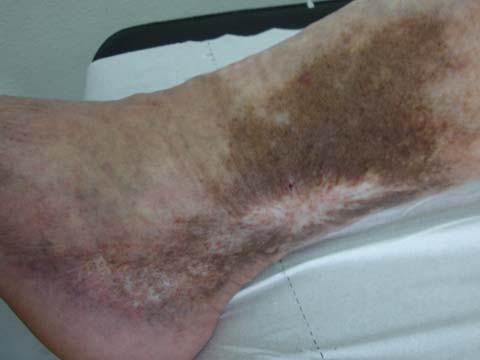 sindrome_Klinefelter_ulceras/dermatitis_ocre_atrofia