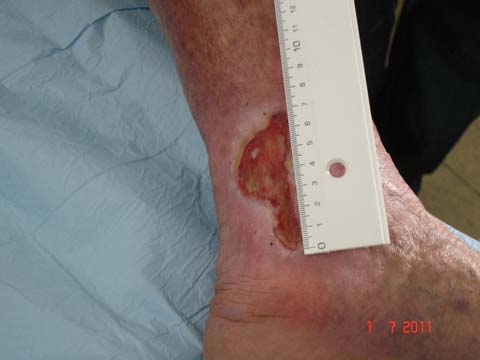 sindrome_Klinefelter_ulceras/ulcera_cronica_venosa