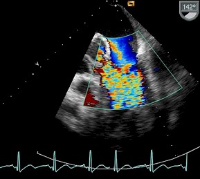 sindrome_febril_infartos/absceso_periaortico_endocarditis