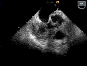 sindrome_febril_infartos/endocarditis_valvula_mitral