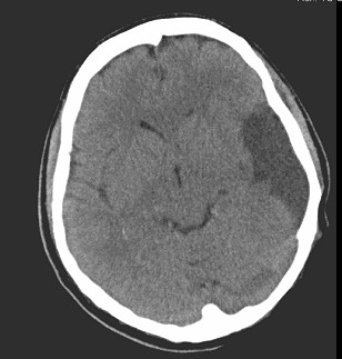 sindrome_febril_infartos/infarto_cerebral_embolia