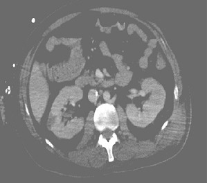 sindrome_febril_infartos/infarto_renal_TAC
