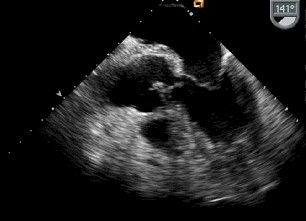 sindrome_febril_infartos/vegetacion_endocarditica_mitral