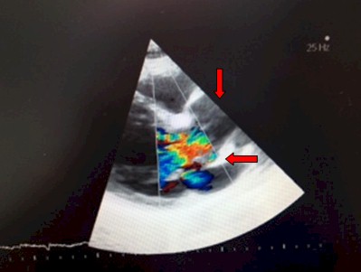 absceso-pseudoaneurisma-endocarditis/ecocardiografia-transesofagica-ultrasonidos