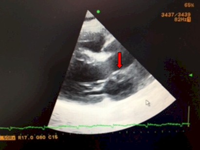 absceso-pseudoaneurisma-endocarditis/union-mitroaortica-ecografia