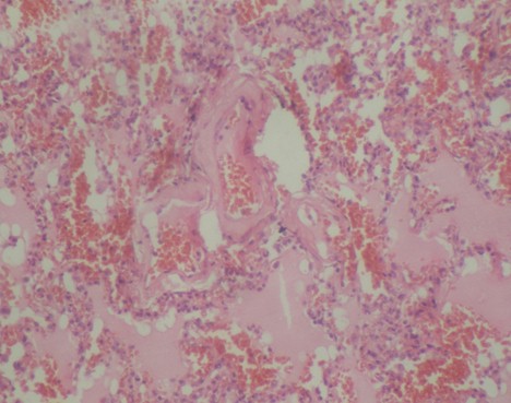 dengue-hemorragia-pulmonar/anatomia-patologica-edema