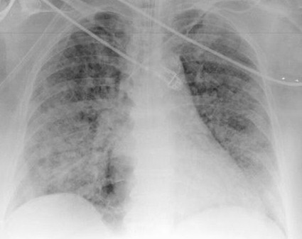 dengue-hemorragia-pulmonar/infiltrado-pulmonar-bilateral