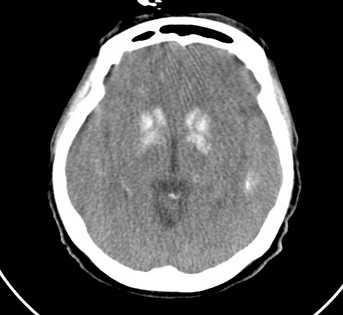 enfermedad-Fahr-caso/TAC-calcificaciones-cerebrales
