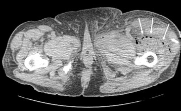 gangrena-gaseosa-postoperatorio/amputacion-infeccion-Clostridium