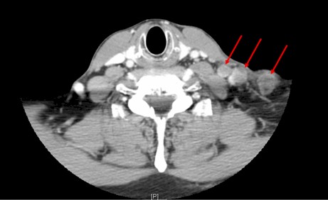 vaciamiento-cervical-posterior/TAC-adenopatias-metastasis