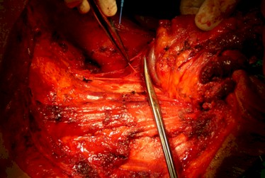 vaciamiento-cervical-posterior/cirugia-trapecio-esternocleidomastoideo