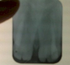 germinacion_dental_caso/camara_pulpar_compartida