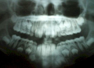 germinacion_dental_caso/incisivos_centrales_superiores