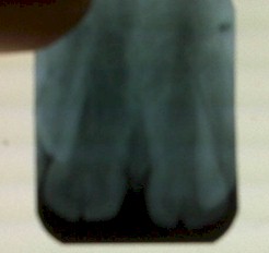 germinacion_dental_caso/rx_radiografia_periapical