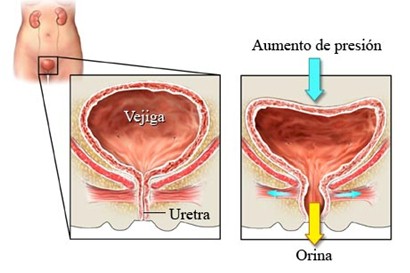 incontinencia_urinaria_causas/esfuerzo_sobreesfuerzo_presion