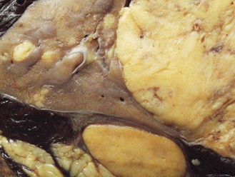 sindrome_Wunderlich_angiomiolipoma/anatomia_patologica_histologia