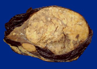 sindrome_Wunderlich_angiomiolipoma/hematoma_perirrenal_tumor