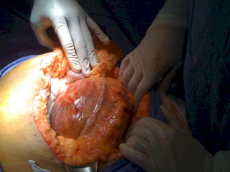 sindrome_Wunderlich_angiomiolipoma/masa_abdominal_cirugia
