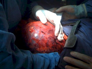 sindrome_Wunderlich_angiomiolipoma/tumor_renal_cirugia