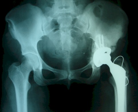 osteolisis_pelvis_pelvica/acetabulo_tornillo_acetabular