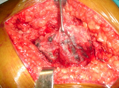 osteolisis_pelvis_pelvica/metalosis_componente_acetabular osteolisis_pelvis_pelvica/metalosis_componente_acetabular
