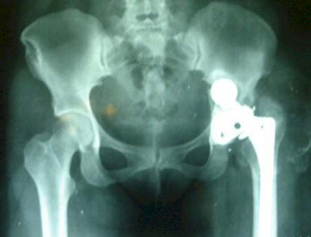 osteolisis_pelvis_pelvica/reemplazo_total_cadera osteolisis_pelvis_pelvica/reemplazo_total_cadera