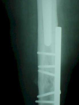 osteolisis_pelvis_pelvica/tornillos_diafisis_femoral