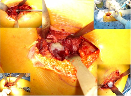 abordaje_lateral_cadera/componente_acetabular_femoral