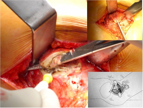 abordaje_lateral_cadera/diseccion_tendinosa_gluteo abordaje_lateral_cadera/diseccion_tendinosa_gluteo