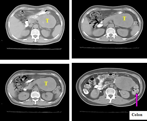 adenocarcinoma_cola_pancreas/TAC_abdomen_colon