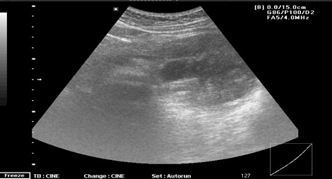 adenocarcinoma_cola_pancreas/ecografia_necrosis_calcificaciones