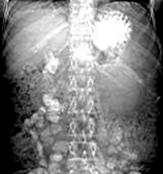 adenocarcinoma_cola_pancreas/topograma_epigastrio_hipocondrio