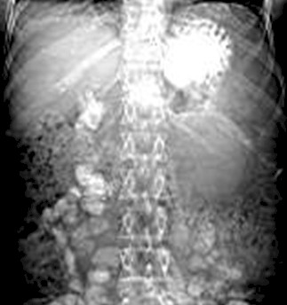 adenocarcinoma_cola_pancreas/topograma_epigastrio_hipocondrio