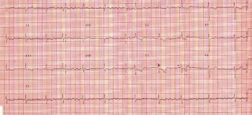 caso_estenosis_mitral/ECG_EKG_electrocardiograma