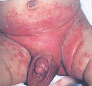 What Is Candida Dermatitis Candida Causes Burning In Stomach