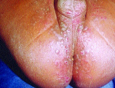 dermatitis_lactante_infantil/granuloma_gluteo_infantil