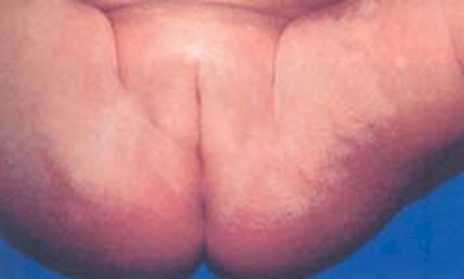 dermatitis_lactante_infantil/hipocromias_residuales dermatitis_lactante_infantil/hipocromias_residuales