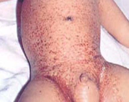 dermatitis_lactante_infantil/histiocitosis_celulas_Langerhans