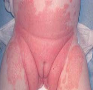dermatitis_lactante_infantil/papulas_placas_papuloescamosas