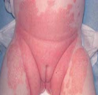 dermatitis_lactante_infantil/papulas_placas_papuloescamosas