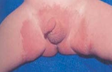 dermatitis_lactante_infantil/rash_W_clinica dermatitis_lactante_infantil/rash_W_clinica
