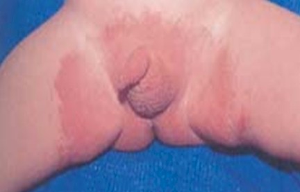 dermatitis_lactante_infantil/rash_W_clinica