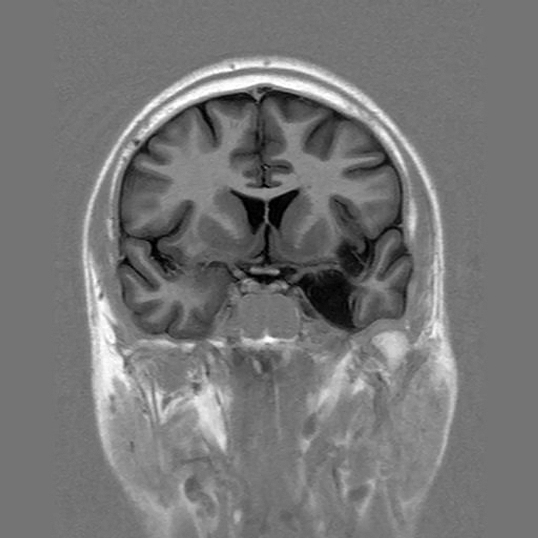 hipocampo_izquierdo_amnesia/RMN_cerebral_cerebro
