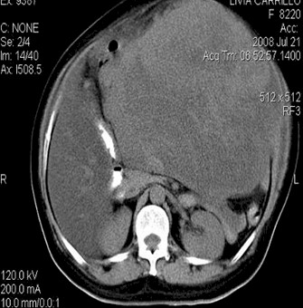 leiomiosarcoma_gigante_utero/TAC_quiste_pulmonar_base