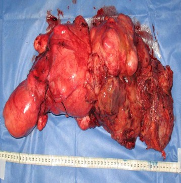 leiomiosarcoma_gigante_utero/extirpacion_tumor_tumores