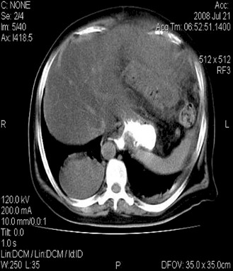 leiomiosarcoma_gigante_utero/fibromatosis_TAC