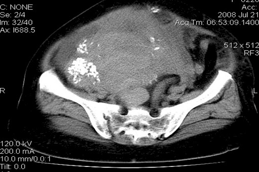 leiomiosarcoma_gigante_utero/gran_masa_tumoral
