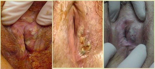 neoplasias_vulvovaginales_benignas/VIN_diferenciado neoplasias_vulvovaginales_benignas/VIN_diferenciado