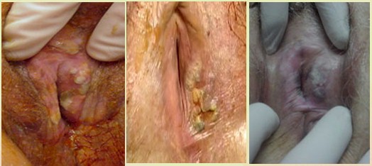 neoplasias_vulvovaginales_benignas/VIN_diferenciado