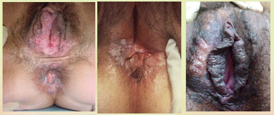 neoplasias_vulvovaginales_benignas/VIN_indiferenciado_bowenoide neoplasias_vulvovaginales_benignas/VIN_indiferenciado_bowenoide